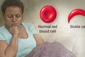 sickle cell