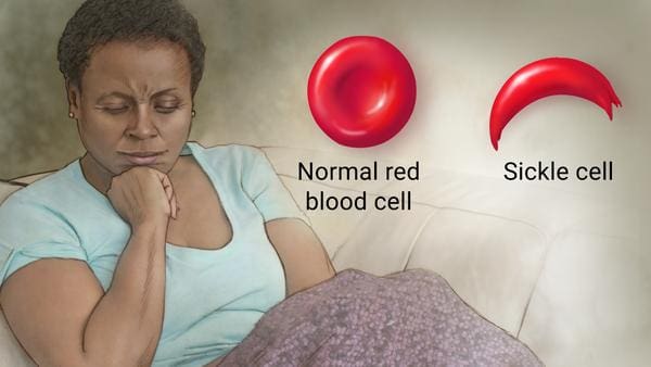 sickle cell